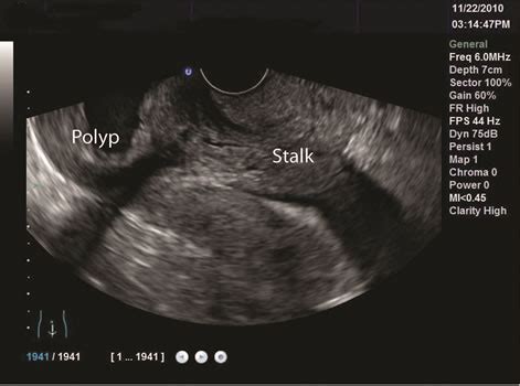 round polyps in uterus